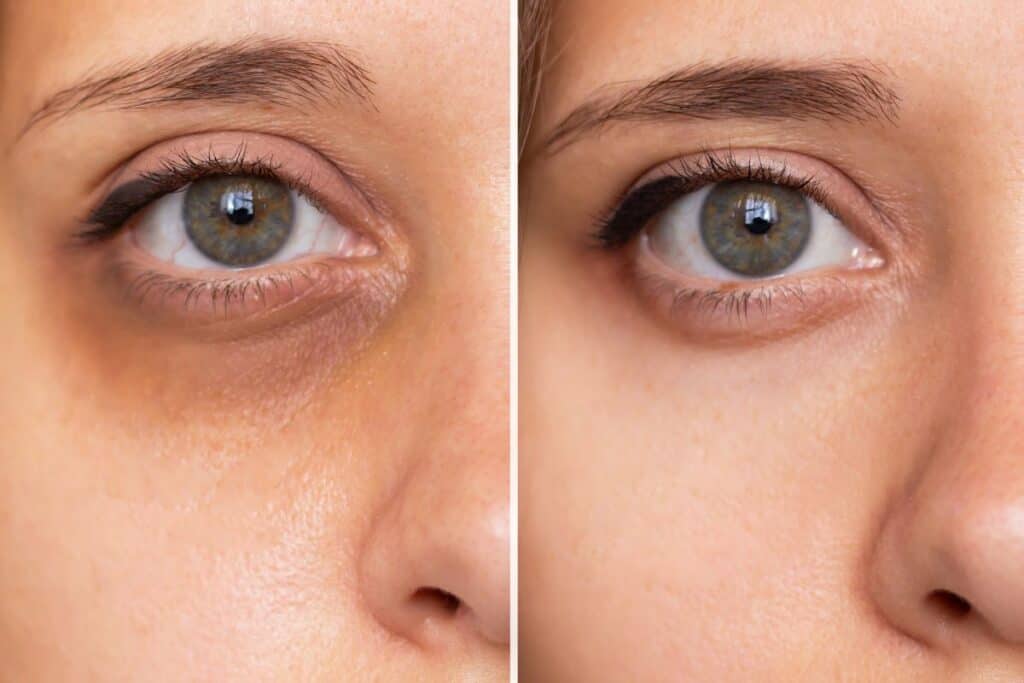 Erase Under Eye Circles Naturally