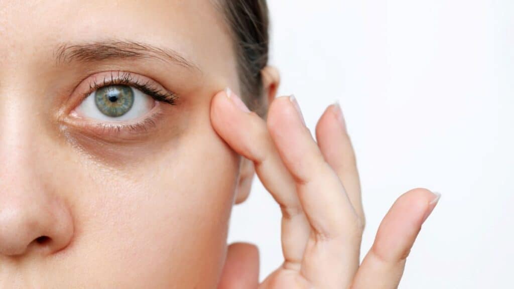 Erase Under Eye Circles Naturally