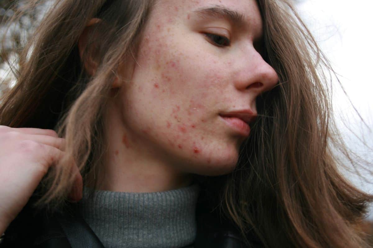 Acne scars and Pigmentation Treatement